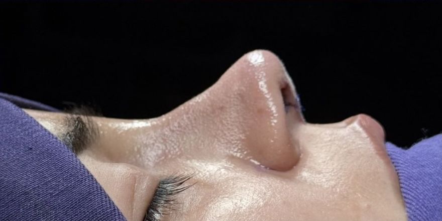 After rhinoplasty, side profile
