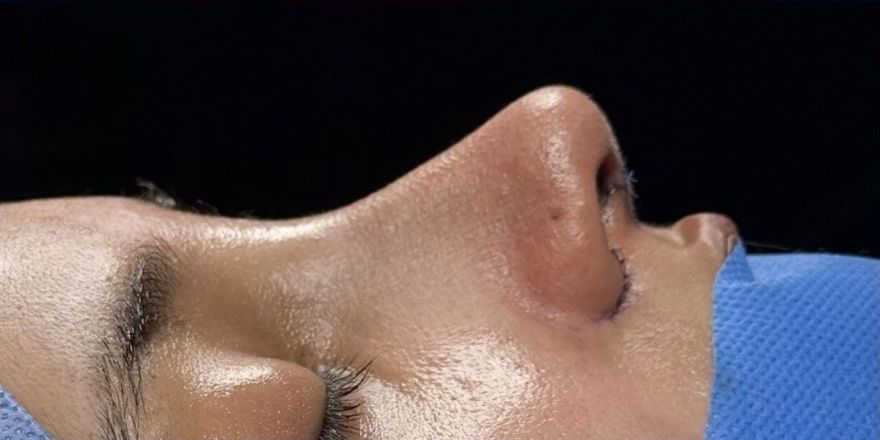 After rhinoplasty, side profile
