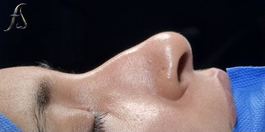 Before rhinoplasty, side profile